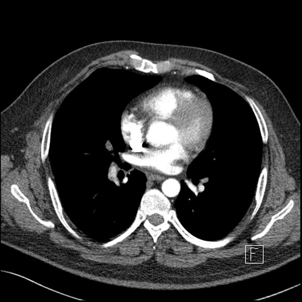 File:Acute pulmonary embolism with pulmonary infarct (Radiopaedia 73062-83768 Axial C+ CTPA 41).jpg