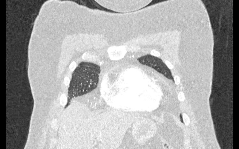 File:Acute pulmonary embolism with pulmonary infarcts (Radiopaedia 77688-89908 Coronal lung window 1).jpg