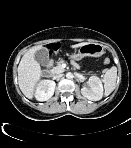 File:Acute pyelonephritis (Radiopaedia 40264-42816 Axial C+ portal venous phase 16).jpg
