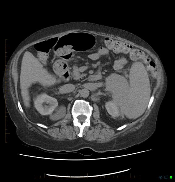 File:Acute renal failure post IV contrast injection- CT findings (Radiopaedia 47815-52557 Axial non-contrast 31).jpg