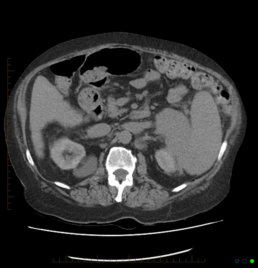 Acute renal failure post IV contrast injection- CT findings (Radiopaedia 47815-52557 Axial non-contrast 31).jpg