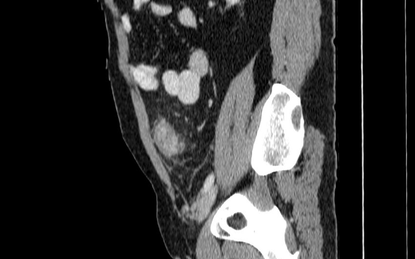 Acute sigmoid colon diverticulitis (Radiopaedia 55507-61976 Sagittal C+ portal venous phase 69).jpg