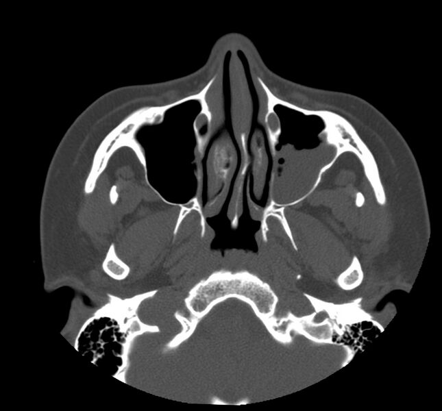 File:Acute sinusitis (Radiopaedia 22419-22455 Axial non-contrast 12).jpg