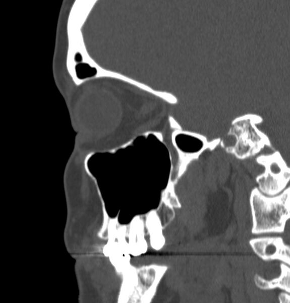 File:Acute sinusitis (Radiopaedia 22419-22455 Sagittal non-contrast 7).jpg