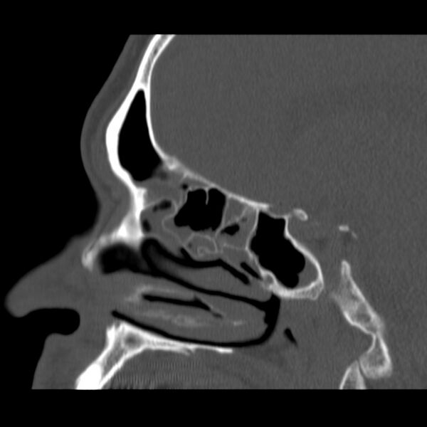 File:Acute sinusitis (Radiopaedia 23161-23215 Sagittal bone window 28).jpg