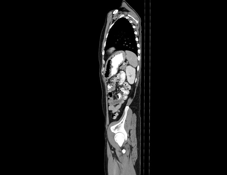 File:Addison disease (Radiopaedia 49318-54412 Sagittal C+ portal venous phase 15).jpg
