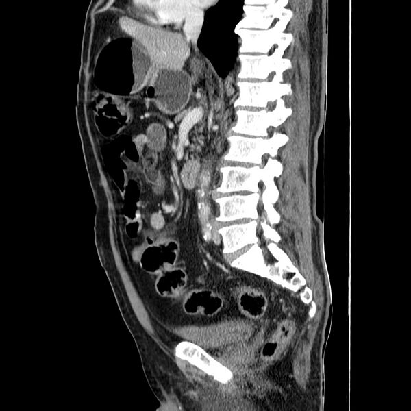 File:Adenocarcinoma of colon with entero-colic fistula (Radiopaedia 22832-22852 Sagittal C+ portal venous phase 31).jpg