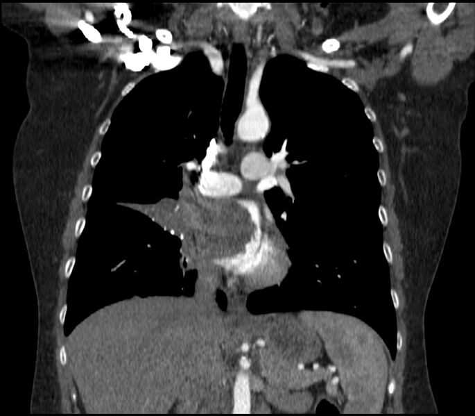 File:Adenocarcinoma of the lung (Radiopaedia 44205-47803 Coronal C+ portal venous phase 43).jpg