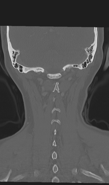 File:Adenoid cystic tumor of palate (Radiopaedia 46980-51518 Coronal bone window 50).png