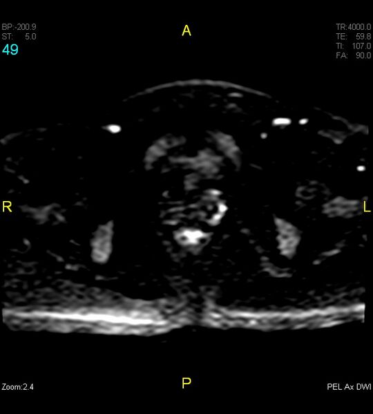 File:Adenomyosis (Radiopaedia 43504-46889 Axial DWI 49).jpg