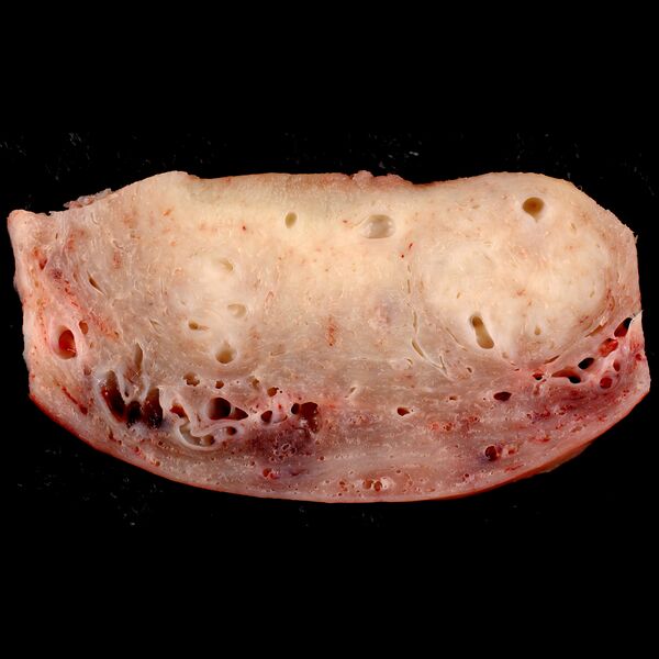 File:Adenomyosis of the uterus (gross pathology) (Radiopaedia 10172).jpeg