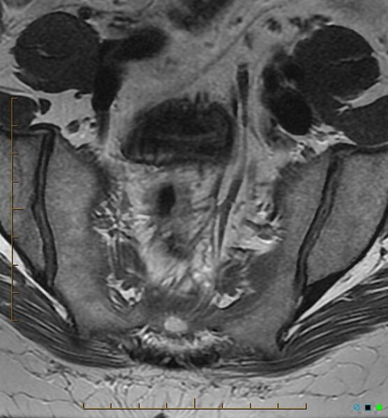 File:Adenomyosis uterus with hematometra (Radiopaedia 45779-50011 Axial T2 2).jpg