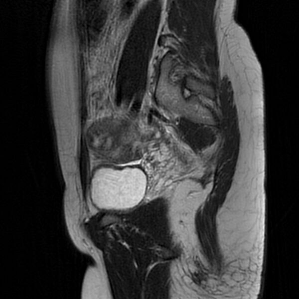 File:Adenomyosis within a septate uterus (Radiopaedia 69963-79981 Sagittal T2 23).jpg