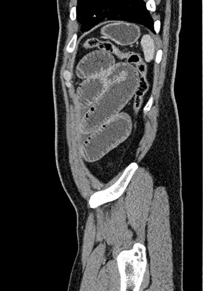 File:Adhesional small bowel obstruction (Radiopaedia 58900-66131 Sagittal C+ portal venous phase 218).jpg