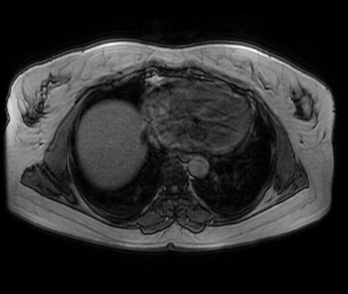 File:Adrenal cortical carcinoma (Radiopaedia 70906-81116 Axial T1 in-phase-out-of-phase 1).jpg