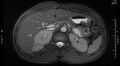 Adrenal pheochromocytoma (Radiopaedia 35133-36730 Axial T2 fat sat 6).jpg