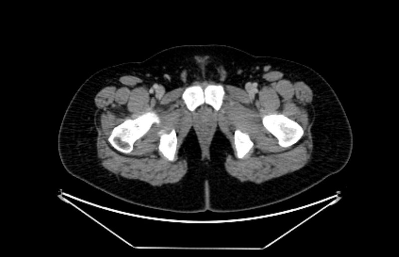 File:Adrenocortical carcinoma (Radiopaedia 80134-93438 Axial C+ portal venous phase 135).jpg