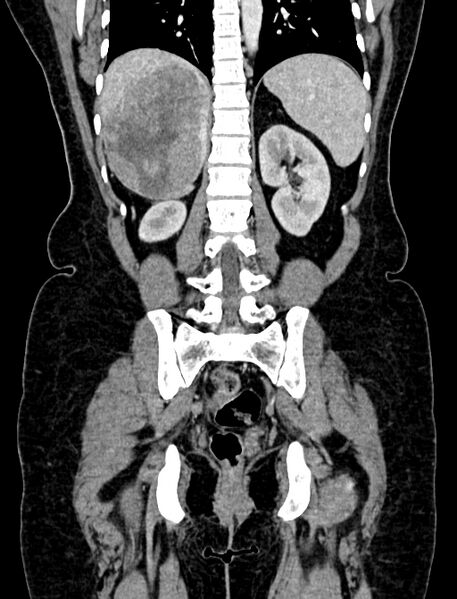 File:Adrenocortical carcinoma (Radiopaedia 87281-103569 Coronal C+ portal venous phase 95).jpg