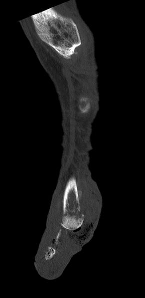 File:Advanced osteomyelitis due to open metatarsal fracture (Radiopaedia 83891-99095 C 3).jpg