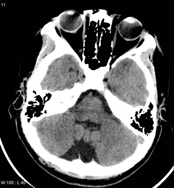 File:Aicardi syndrome (Radiopaedia 5353-7116 Axial non-contrast 8).jpg