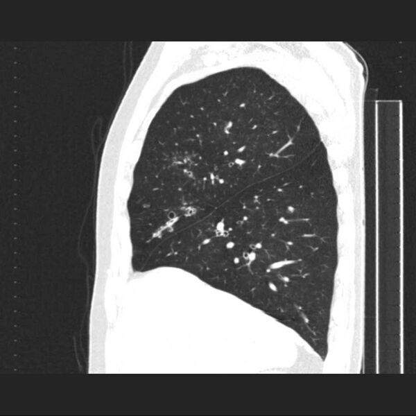 File:Allergic bronchopulmonary aspergillosis (Radiopaedia 21386-21320 Sagittal lung window 14).jpg
