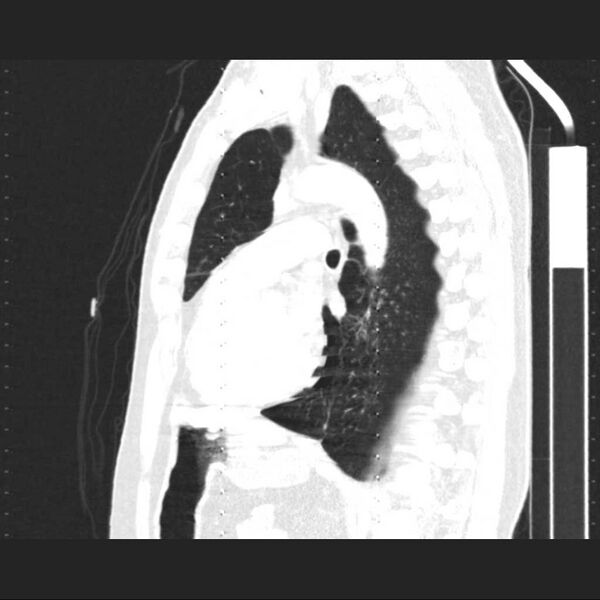 File:Allergic bronchopulmonary aspergillosis (Radiopaedia 21386-21320 Sagittal lung window 8).jpg