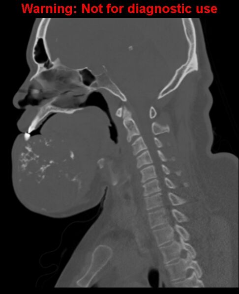 File:Ameloblastoma (Radiopaedia 33126-34164 Sagittal bone window 39).jpg
