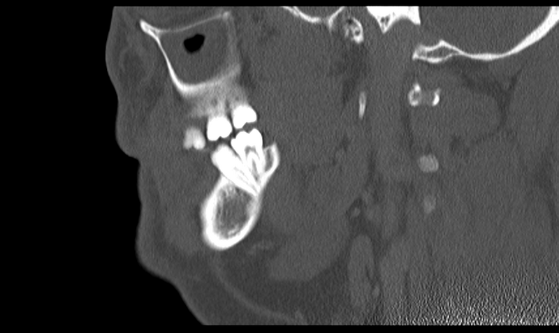 File:Ameloblastoma (Radiopaedia 33677-34806 Sagittal bone window 43).png
