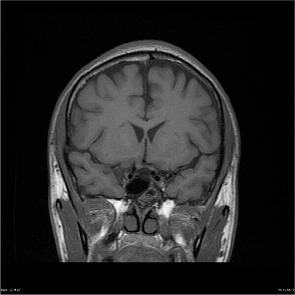 File:Amnestic syndrome secondary to hypoxic brain injury (Radiopaedia 24743-25004 B 17).jpg