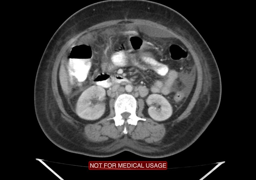 Amoebic enterocolitis with liver abscess (Radiopaedia 35100-36609 A 37).jpg
