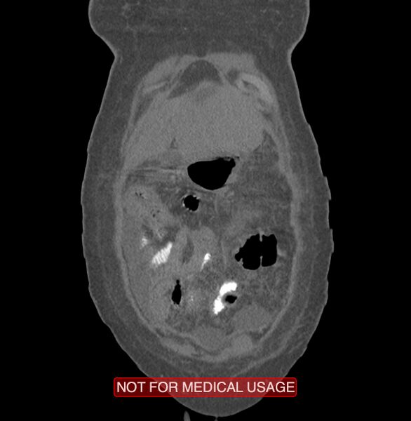 File:Amoebic enterocolitis with liver abscess (Radiopaedia 35100-36609 B 5).jpg