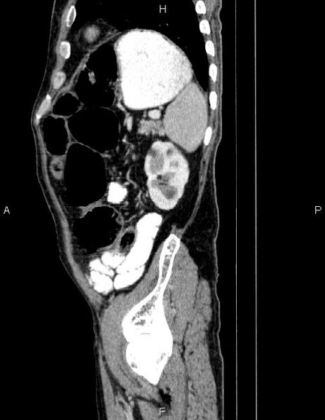 File:Ampullary adenocarcinoma (Radiopaedia 86093-102032 D 79).jpg