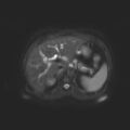 Ampullary tumor (Radiopaedia 27294-27479 T2 SPAIR 13).jpg