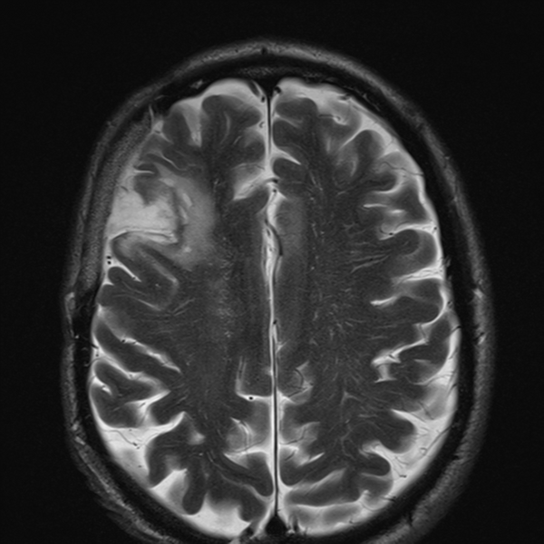 File:Anaplastic meningioma with recurrence (Radiopaedia 34452-35788 Axial T2 20).png