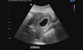 Anembryonic pregnancy and ovarian dermoid cyst (Radiopaedia 62534).jpg
