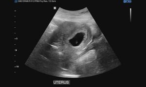 Ultrasound: failed early pregnancy