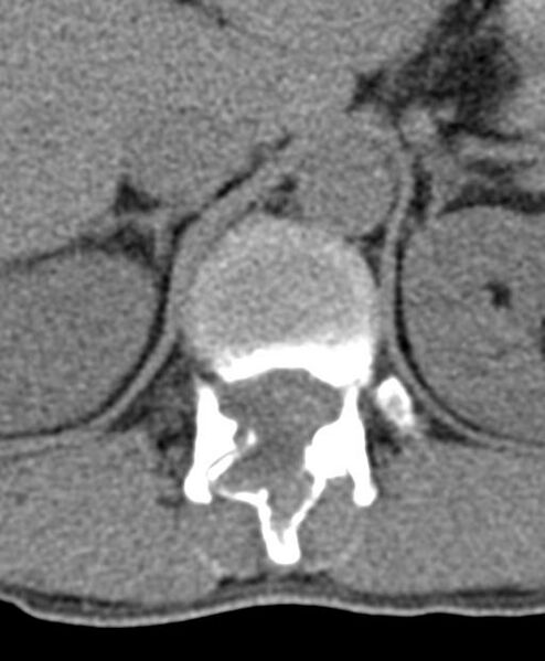 File:Aneurysmal bone cyst T11 (Radiopaedia 29294-29721 Axial non-contrast 49).jpg