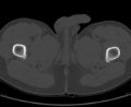 Aneurysmal bone cyst of ischium (Radiopaedia 25957-26094 Axial bone window 85).png