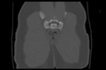 Aneurysmal bone cyst of ischium (Radiopaedia 25957-26094 Coronal bone window 42).png