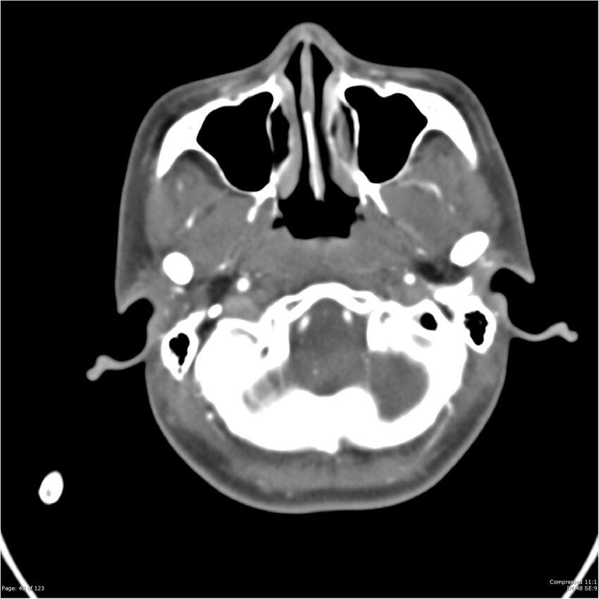 Aneurysmal subarachnoid hemorrhage and Moya Moya disease (Radiopaedia 34306-35593 Axial CT COW 48).jpg