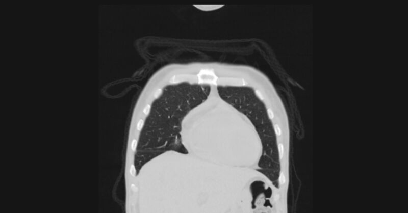 File:Angioinvasive aspergellosis (Radiopaedia 66995-76315 Coronal lung window 10).jpg