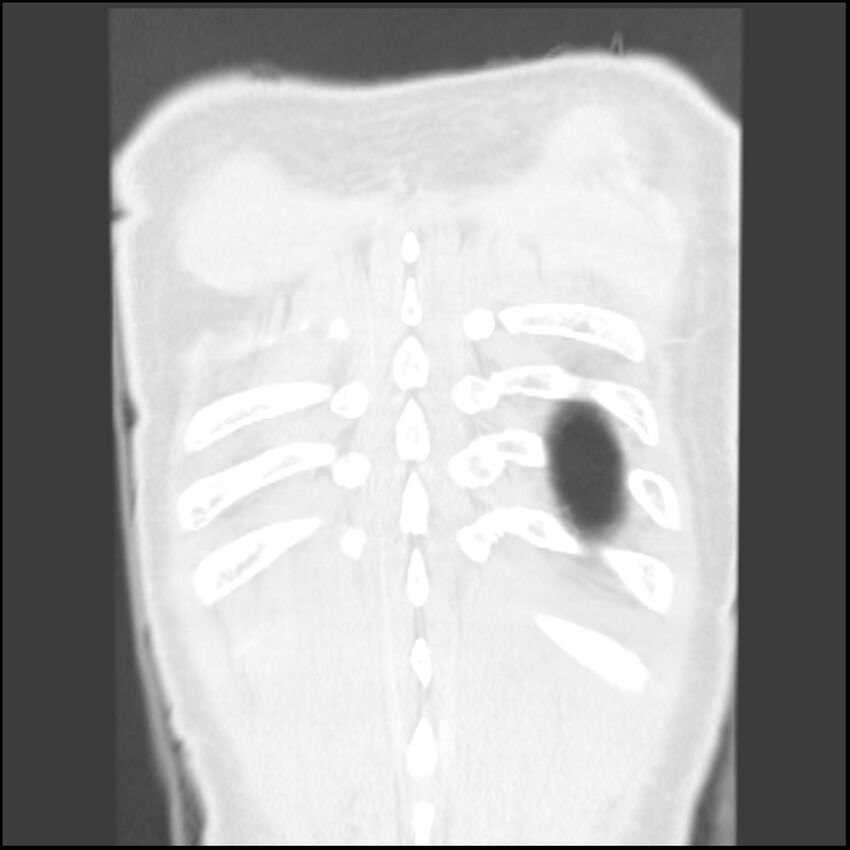 Angioinvasive aspergillosis (Radiopaedia 43957-47466 Coronal lung window 2).jpg