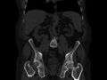 Ankylosing spondylitis (Radiopaedia 44609-48357 Coronal bone window 40).jpg