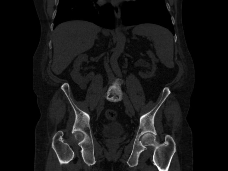 File:Ankylosing spondylitis (Radiopaedia 44609-48357 Coronal bone window 40).jpg