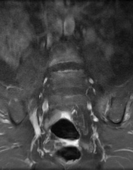 File:Ankylosing spondylitis - Andersson lesion (Radiopaedia 81878-95838 H 4).jpg