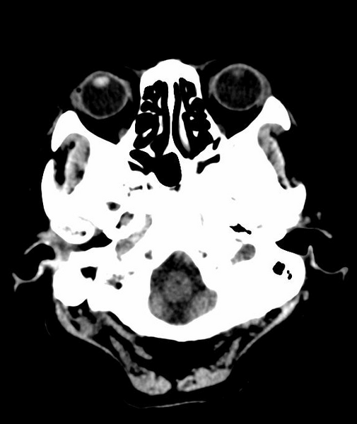 File:Anomalous intracranial venous drainage (Radiopaedia 28161-28418 Axial 57).png