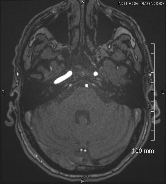 File:Anterior cerebral artery aneurysm (Radiopaedia 80683-94127 Axial MRA 55).jpg