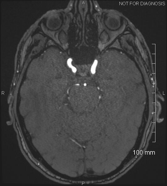 File:Anterior cerebral artery aneurysm (Radiopaedia 80683-94127 Axial MRA 81).jpg