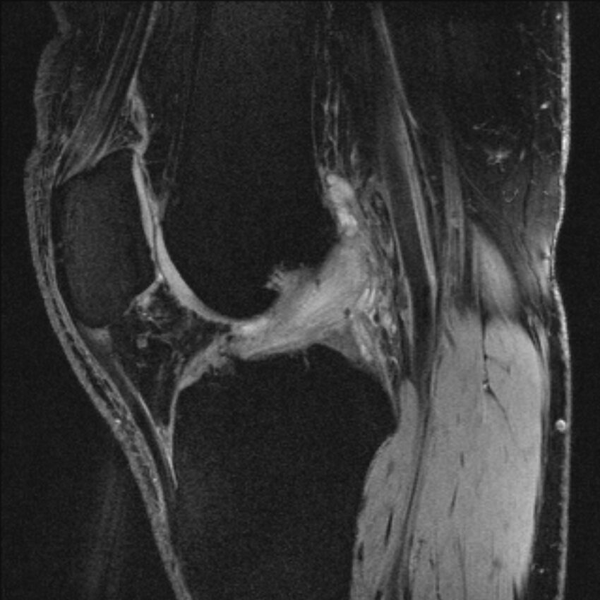 Anterior cruciate ligament mucoid degeneration (Radiopaedia 68400-77933 Sagittal 30).jpg
