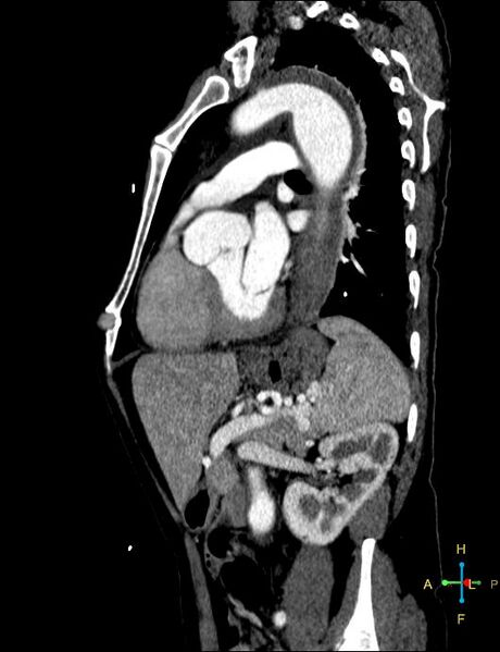 File:Aortic aneurysm and penetrating ulcer (Radiopaedia 23590-23704 C 4).jpg